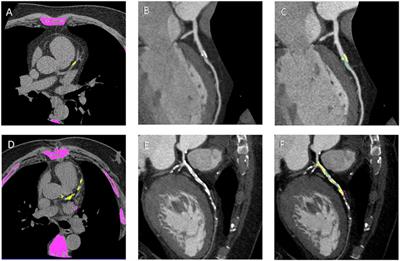 In Vivo and In Vitro Analysis in Coronary Artery Disease Related to Type 2 Diabetes